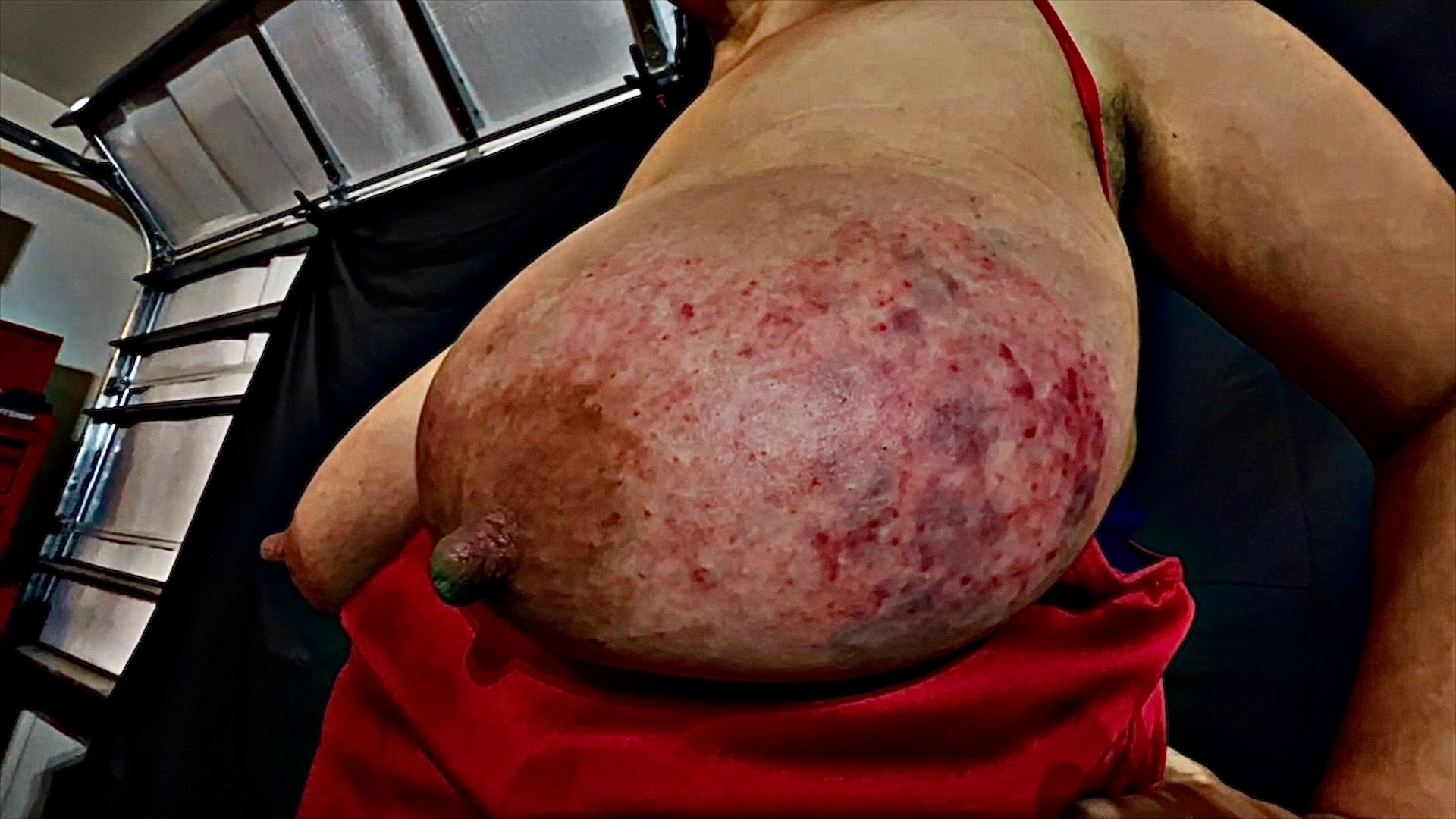 Tits bruised